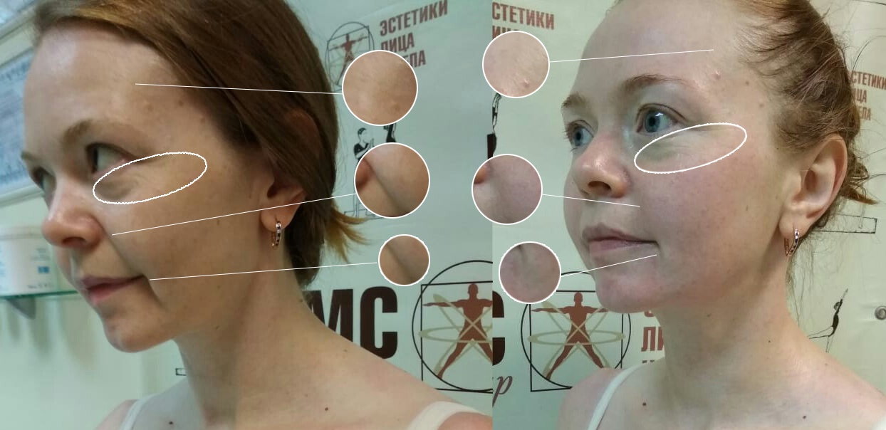 Биомеханическая стимуляция мышц — альтернатива скальпелю и ботоксу